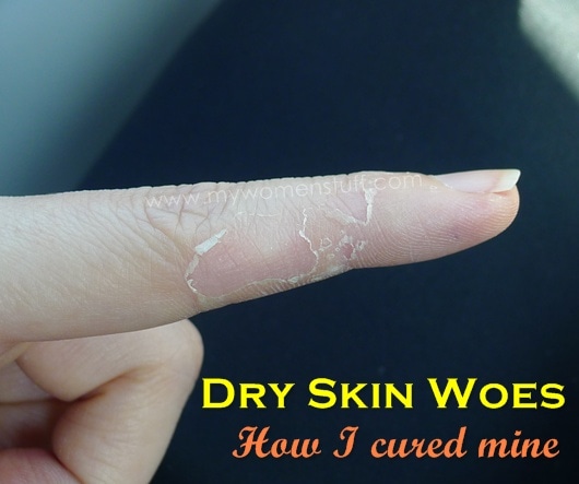 dry skin on my hands and how I cure it